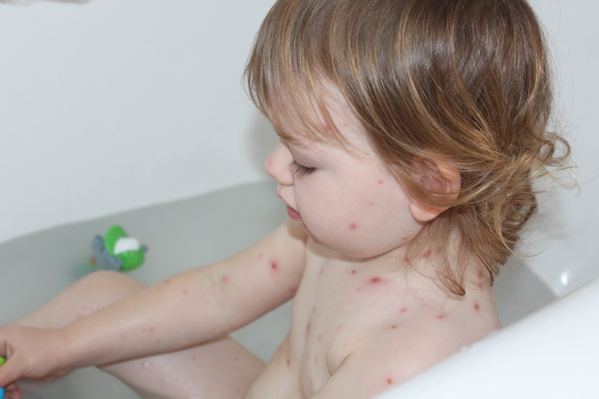 How to treat with chicken pox - Roseyhome - chicken pox, illness, sickness, childhood illness, how to treat